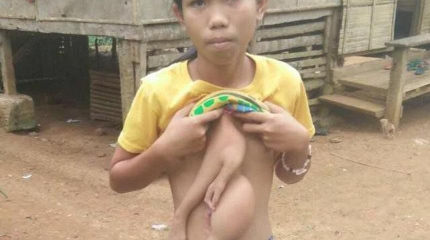 Ana rahminde ikizini yedi! Şimdi ameliyat g&uuml;n&uuml;n&uuml; bekliyor!