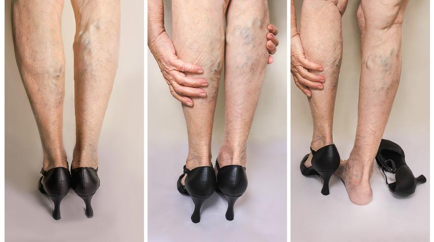 Varis tedavisi hakkında bilmeniz gerekenler: Varis nedir, neden olur?