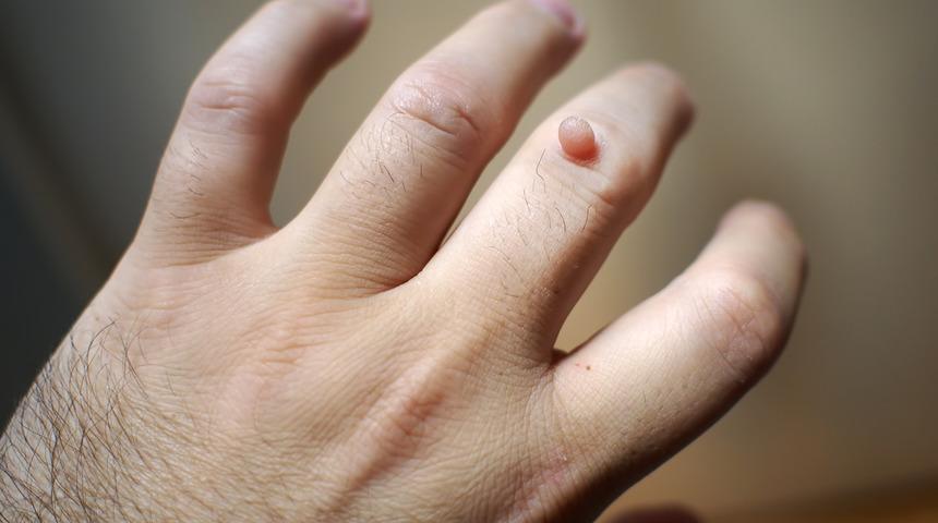 Siğil Neden Olur, Nasıl Tedavi Edilir?