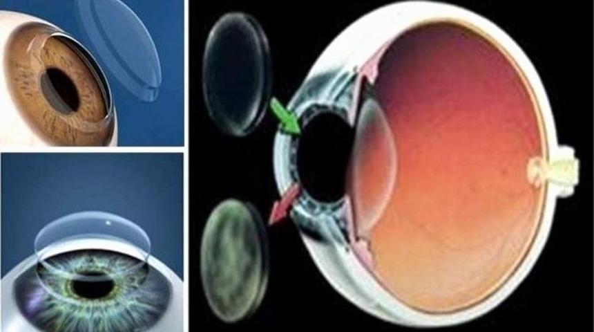 Ad&uuml;&rsquo;den Kornea Naklinde B&uuml;y&uuml;k Başarı
