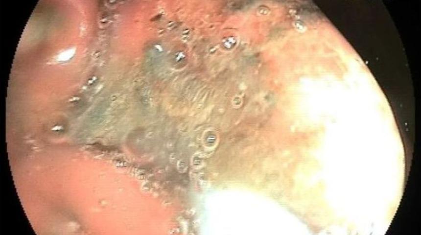 Mahkumun Midesinden 8 Adet Kalem Pili &Ccedil;ıktı