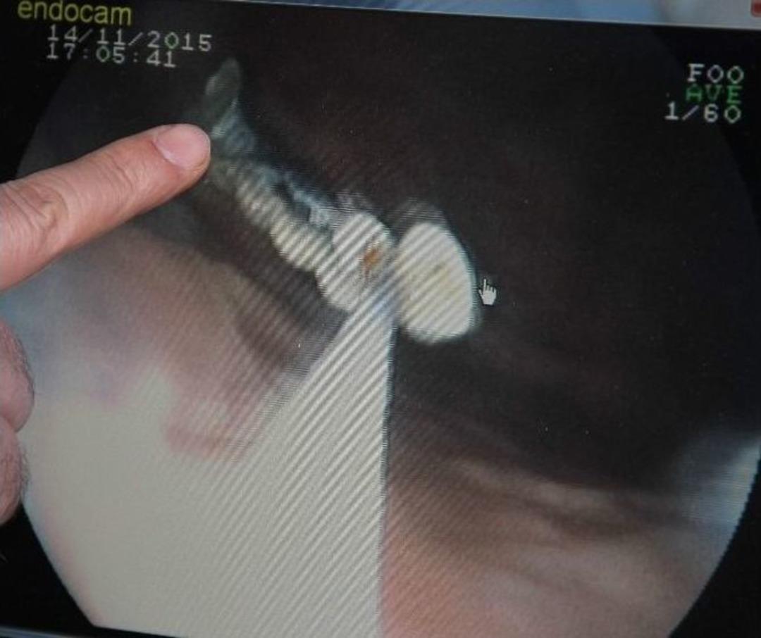 Kaybettiği 5 Dişi Bağırsaklarından &Ccedil;ıktı