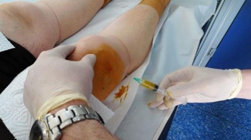 Diz Ağrıları Prp İle Tarih Oluyor