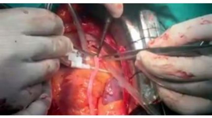 &Ccedil;alışan Kalbe Bypass