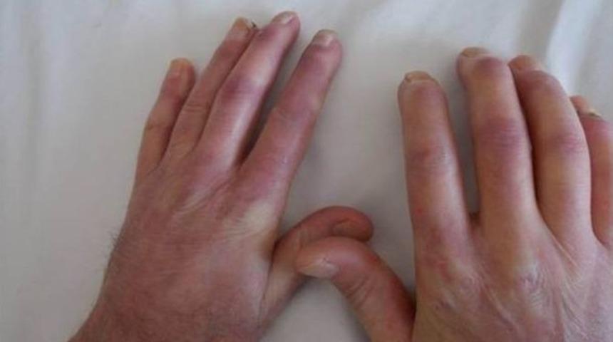 Raynaud Belirtisi Romatizmanın Habercisi Olabilir