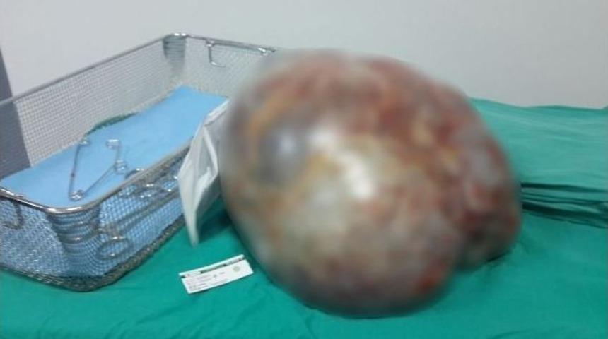 Karın Ağrısıyla Gitti, Futbol Topu B&uuml;y&uuml;kl&uuml;ğ&uuml;nde Ur &Ccedil;ıktı