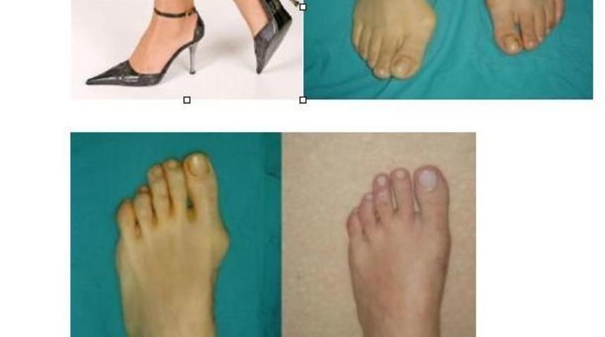 Ayaklarda Ağrıyla Ortaya &Ccedil;ıkan &Ccedil;arpıklığa Dikkat