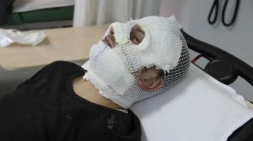 Yanan Ateşe Tiner D&ouml;k&uuml;nce Hastanelik Oldu