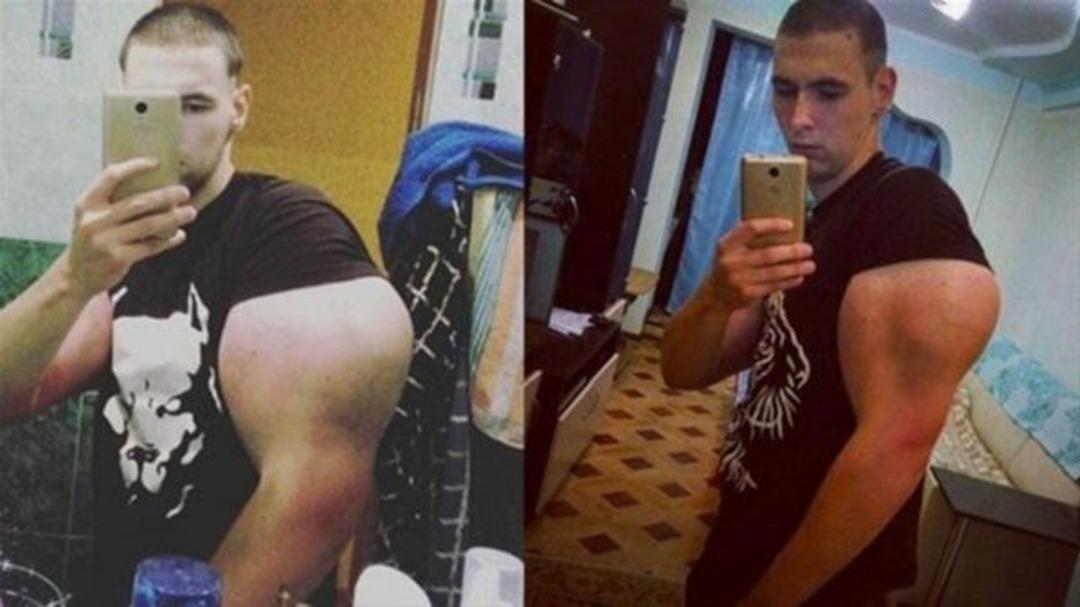 Kollarına 'kas' enjekte ediyordu! Son hali bakın nasıl oldu