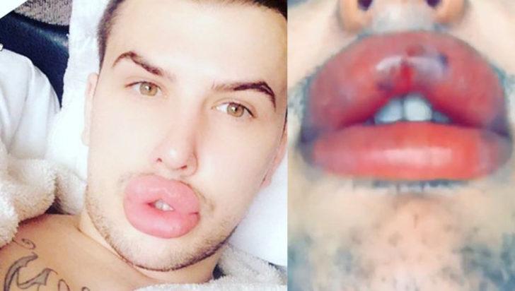 Estetik bağımlılığı yüzünden dudakları patlama noktasına geldi G1