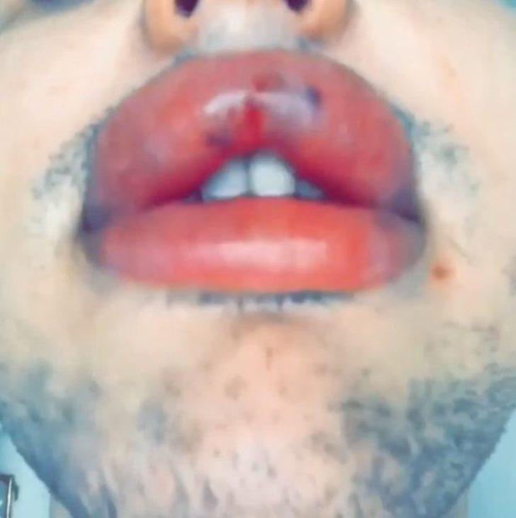 Estetik bağımlılığı yüzünden dudakları patlama noktasına geldi G2