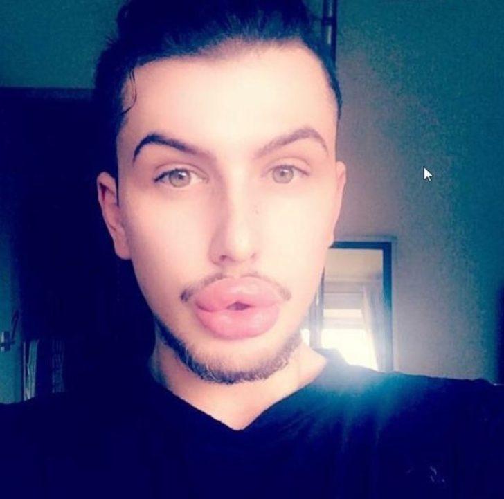 Estetik bağımlılığı yüzünden dudakları patlama noktasına geldi G4