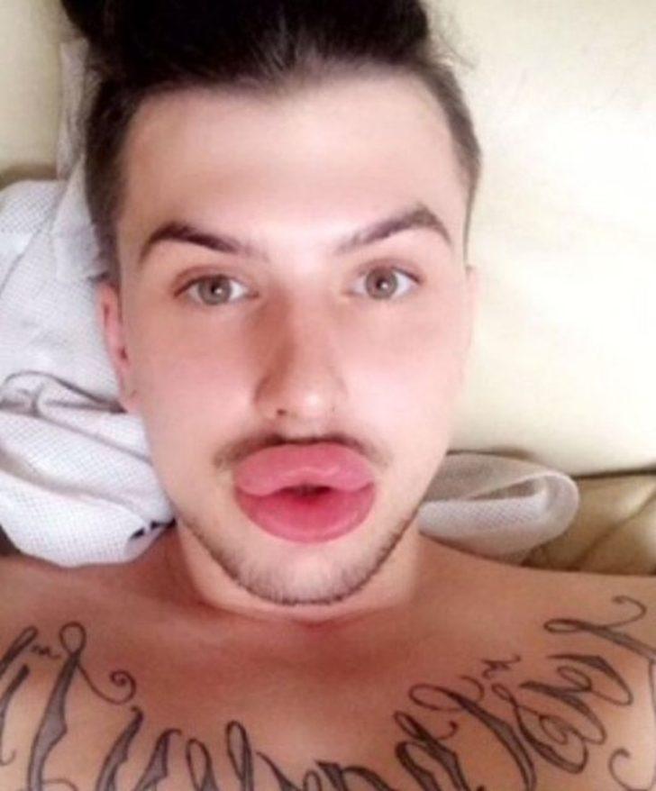 Estetik bağımlılığı yüzünden dudakları patlama noktasına geldi G5