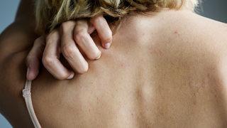 Kurdeşen nedir, nasıl geçer?