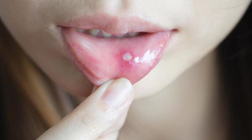 Dil kanseri belirtileri nelerdir?