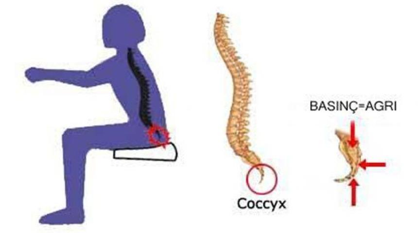 Kuyruk sokumu ağrısı neden olur? Kuyruk sokumu ağrısı tedavisi ameliyatsız mümkün mü?