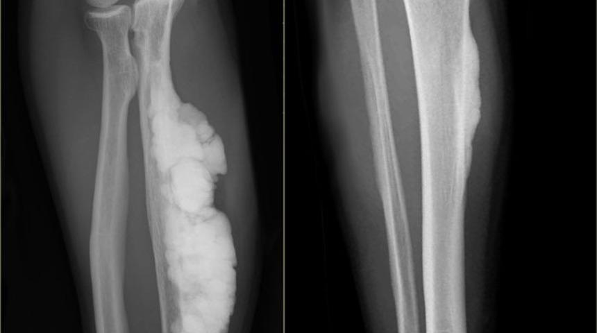 Kemiğin paget hastalığı nedir? Kemiğin paget hastalığı belirtisi nelerdir? Kemiğin paget hastalığı tedavisi nasıl gerçekleşir