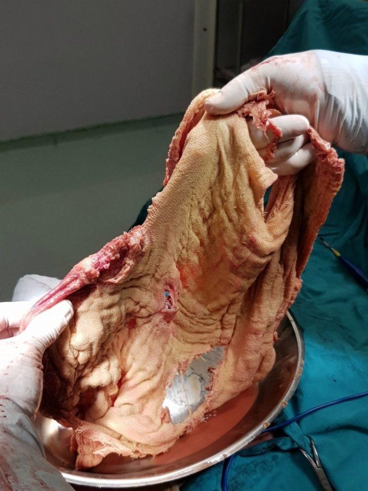 12 yaşındaki kızın midesinden bakın neler çıktı G4