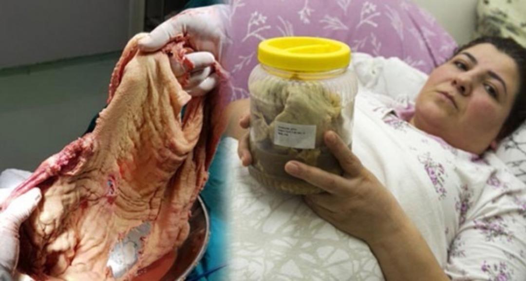 Tam 1.8 kilo! Midesinden &ccedil;ıkanı g&ouml;renler g&ouml;zlerine inanamadı