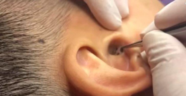 Kulağından çıkanı görenler gözlerine inanamıyor G1