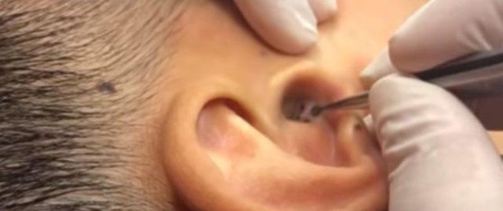 Kulağından çıkanı görenler gözlerine inanamıyor G2