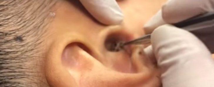 Kulağından çıkanı görenler gözlerine inanamıyor G3