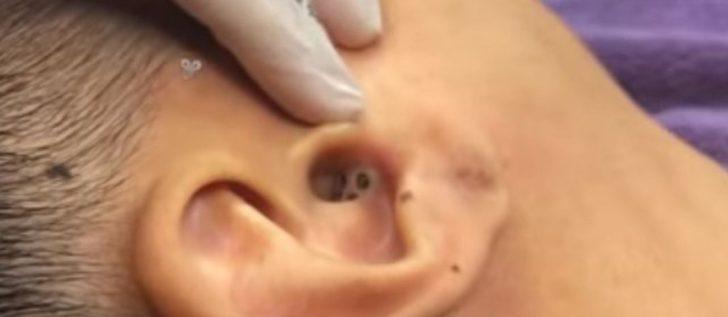 Kulağından çıkanı görenler gözlerine inanamıyor G5