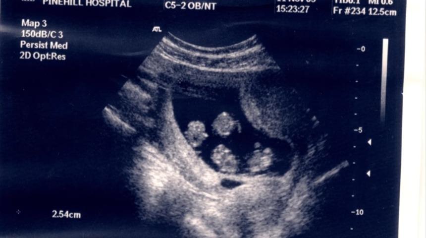 64 milyonda bir ger&ccedil;ekleşen mucize!