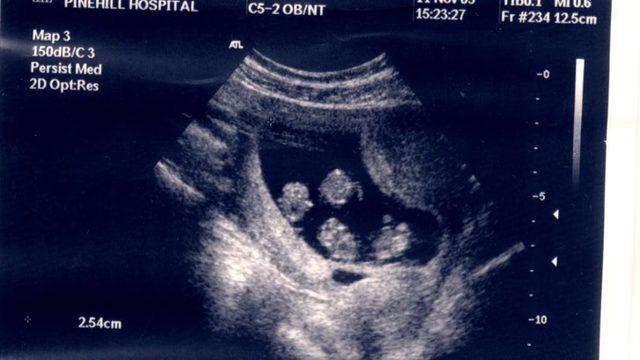 64 milyonda bir gerçekleşen mucize!