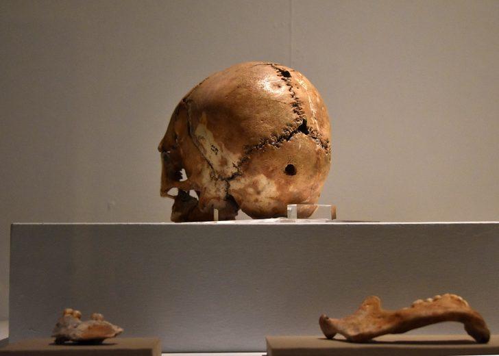 İşte 10 bin yıl önce ilk beyin ameliyatı yapılan kafatası  G3