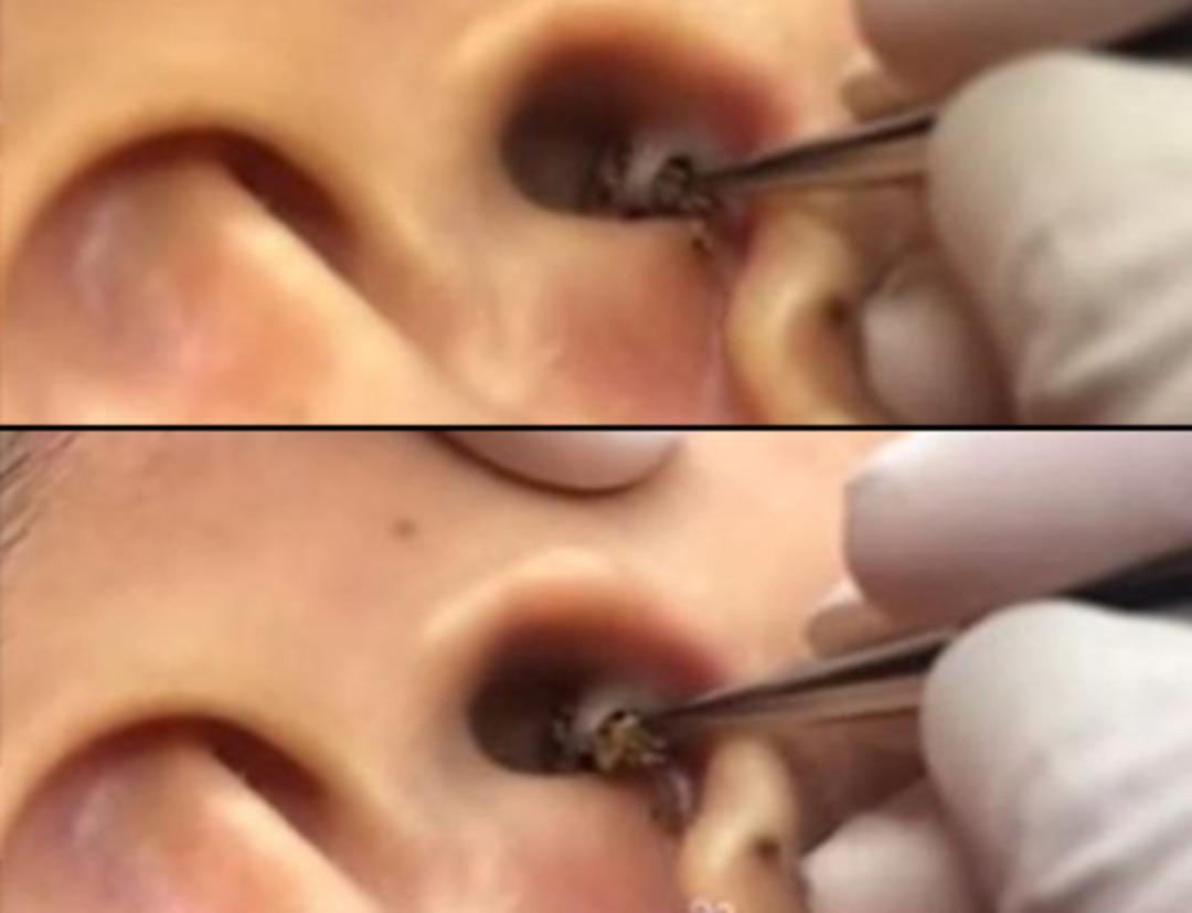 Kulağından &ccedil;ıkanı g&ouml;renler g&ouml;zlerine inanamıyor