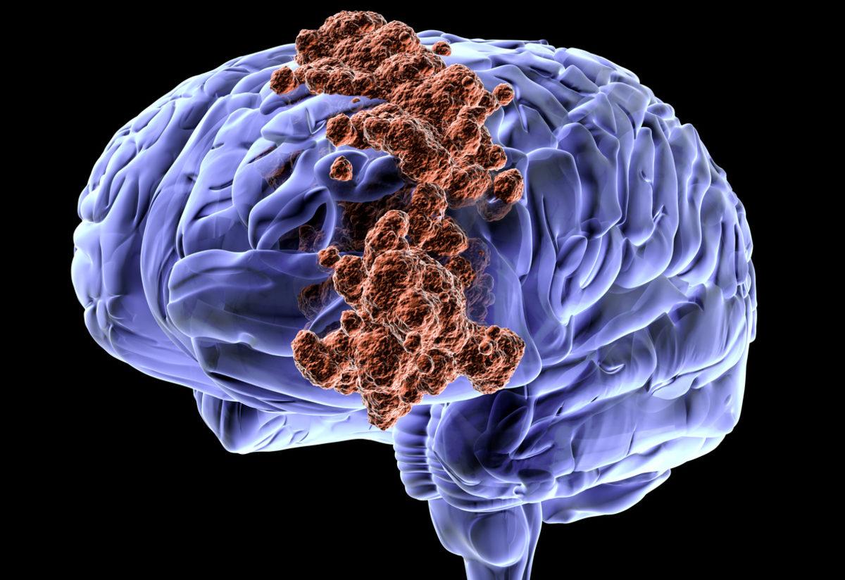 beyin kanseri belirtileri nelerdir