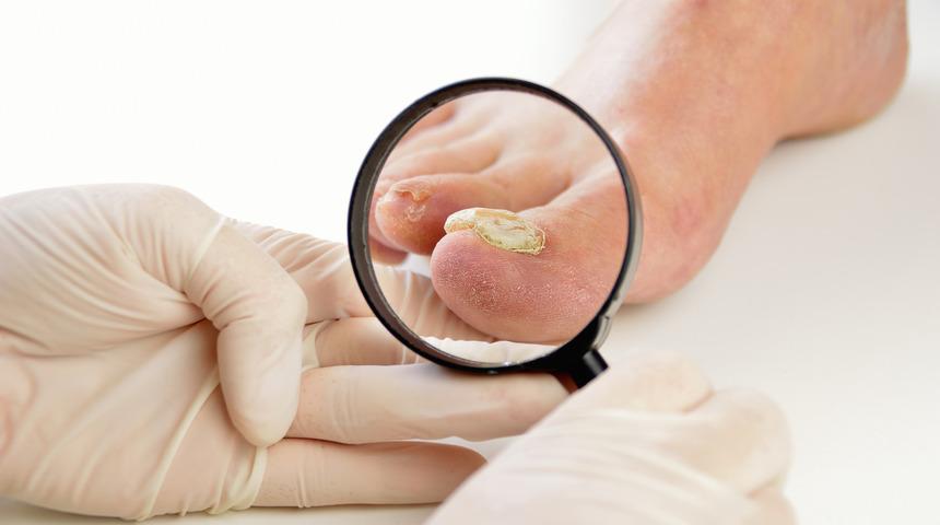 Tırnak mantarı ilacı nedir, tedavisi nasıl olur? 