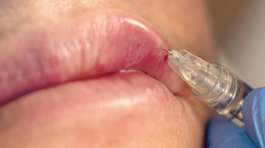 Botoks sadece kırışıklıkları gidermiyor! Bakın başka hangi sorunları çözüyor