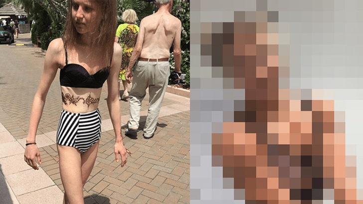 Anoreksiya hastası genç kız ölümden döndü!  G1