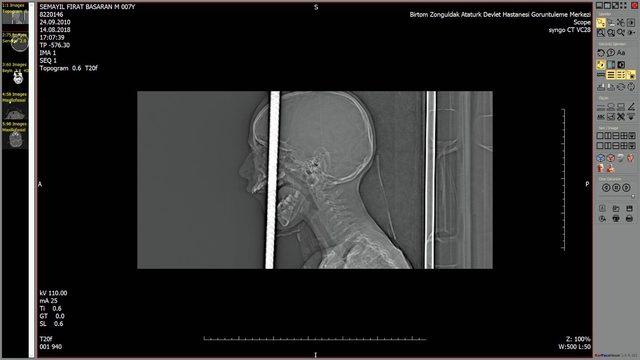 K&uuml;&ccedil;&uuml;k Fırat ın başına giren inşaat demiri ameliyatla &ccedil;ıkarıldı 2