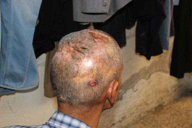 Kafasında 30 çivi, onlarca toplu iğneyle yaşıyor! G4