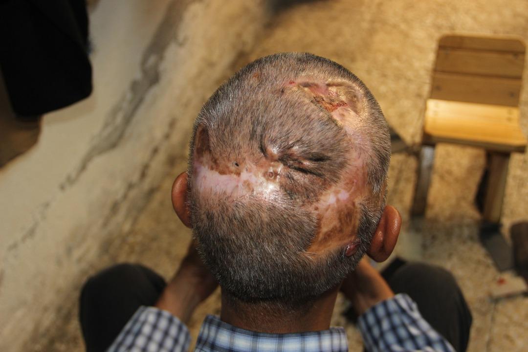 Kafasında 30 &ccedil;ivi, onlarca toplu iğneyle yaşıyor!