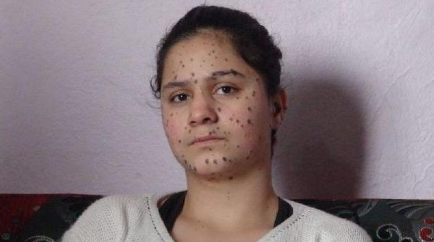 V&uuml;cudunu Siyah Benler Saran 13 Yaşındaki Kız Tedavi Olmak Istiyor