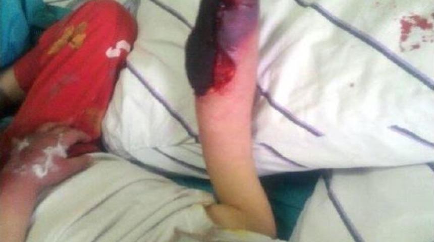 'yanlış Takılan Serum Kangren Etti' Iddiası