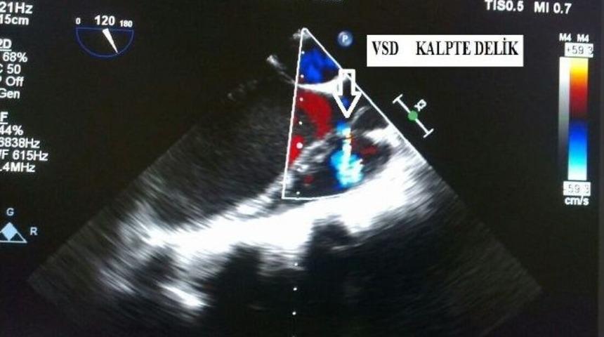 Sa&uuml;&rsquo;de Başarılı Bir Ameliyata Daha İmza Atıldı