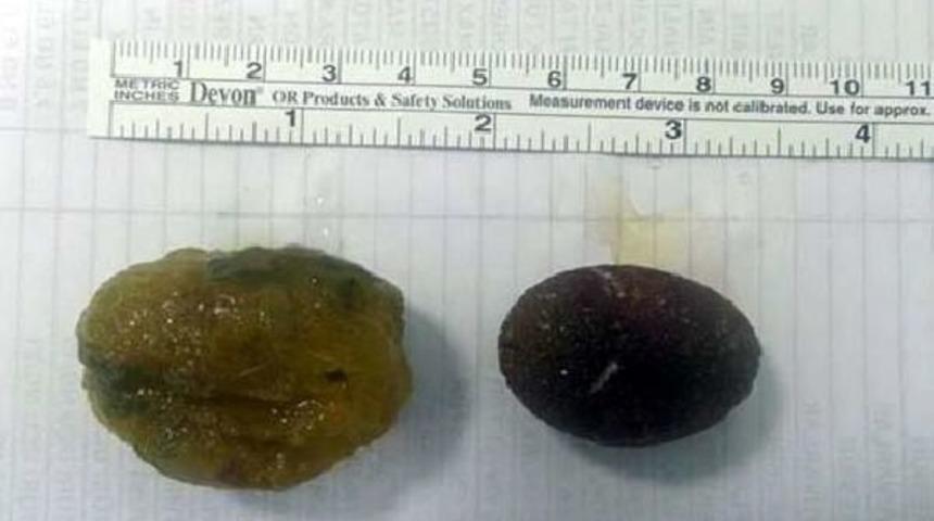 Bağırsağından Taşlaşmış Yiyecek Kalıntısı &Ccedil;ıktı