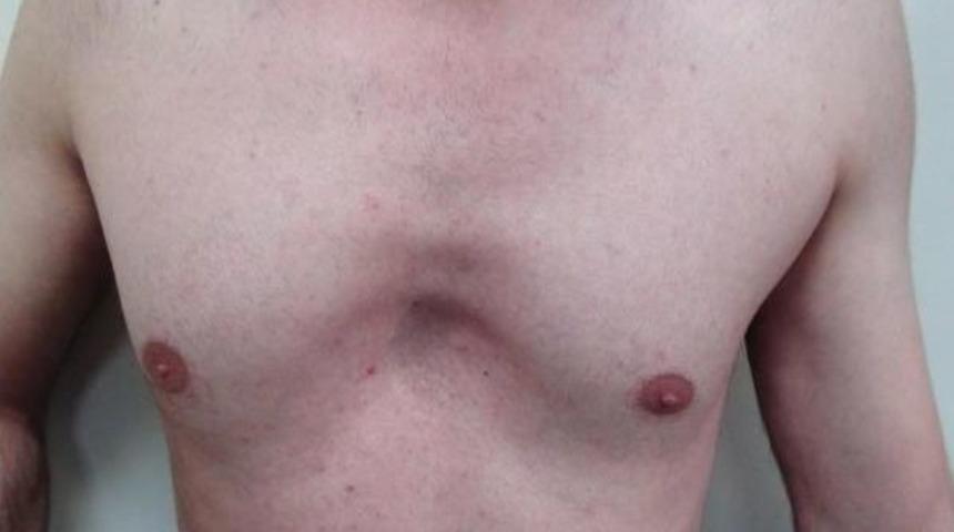 G&ouml;ğ&uuml;s Kafesi &Ccedil;elik Barla D&uuml;zeltildi