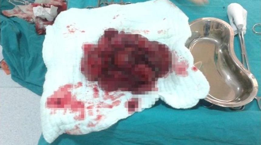 Karnından &Uuml;&ccedil; Kiloluk Kitle &Ccedil;ıktı