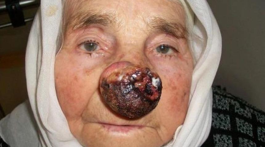 Zehra Nine'ye Nefes Aldıran Operasyon