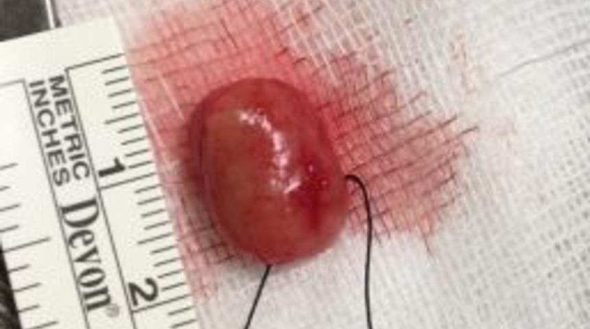 &ldquo;bel Fıtığıyım&rdquo; Dedi, Omurilik T&uuml;m&ouml;r&uuml; &Ccedil;ıktı