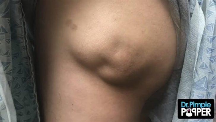 Kalçasından çıkanlar şoke etti  G1