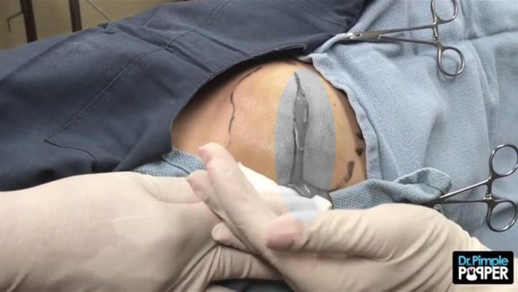 Kalçasından çıkanlar şoke etti  G2