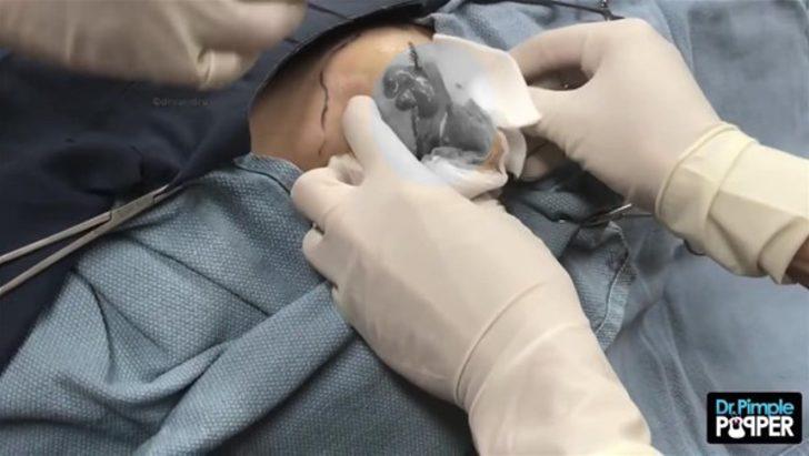 Kalçasından çıkanlar şoke etti  G3