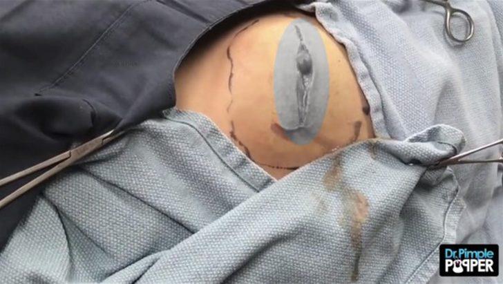 Kalçasından çıkanlar şoke etti  G4